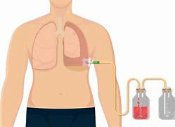 Image result for Chest Tube Patient