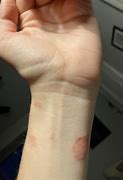 Image result for Apple Watch Band Allergy