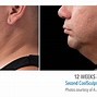 Image result for Fat Freeze Double Chin
