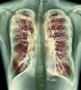 Image result for Cystic Fibrosis Lung Disease