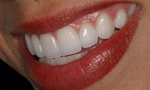 Image result for London Look Teeth