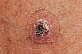 Image result for Basal Cell Carcinoma On Black Skin