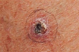 Image result for Basal Cell Carcinoma Skin Cancer On Leg