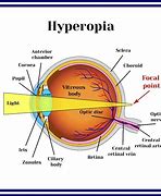 Image result for Hyperopia