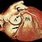 Image result for Coronary Artery Anomaly