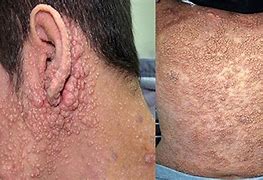 Image result for Molluscum Skin Condition