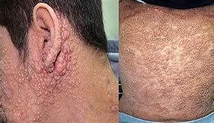 Image result for Molluscum Contagiosum After Treatment