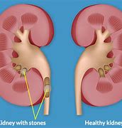 Image result for Kidney Stones and Blood in Urine