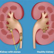 Image result for Kidney Stone Appearance