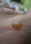 Image result for Flat Warts