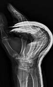 Image result for iPhone at Splint