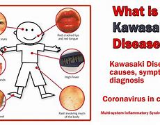 Image result for Casue of Kawasaki Disease