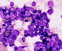 Image result for Acute Lymphocytic Leukemia Bone Marrow Aspiration