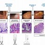 Image result for Serrated Polyps Colon