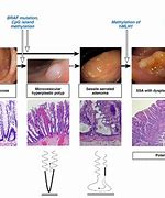 Image result for Sessile Polyps in Colon
