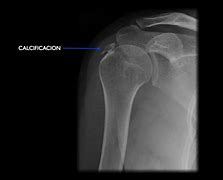 Image result for calcificar