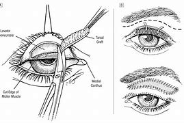 Image result for Molluscum On Eyelid