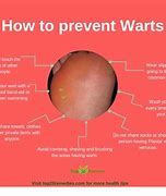 Image result for Red Genital Warts