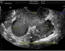 Image result for Endometrioma On Ultrasound