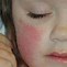 Image result for Fifth Disease Rash Treatment