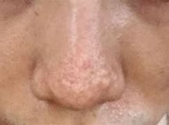 Image result for Dermabrasion Back Acne Scars
