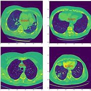 Image result for Nodules On Lungs in CT Scan