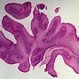 Image result for Esophageal Papilloma