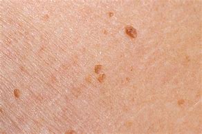 Image result for Papilloma On Human Skin