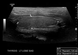 Image result for thyroid ultrasound pics