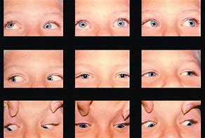 Image result for diplopia