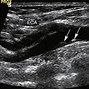 Image result for Carotid Ultrasound