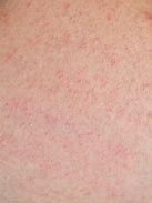 Image result for Alregic Skin Rash