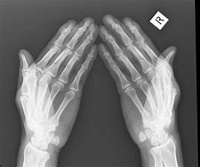 Image result for Psoriatic Arthritis Hands XR