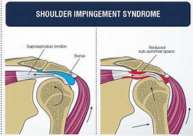 Image result for Subacromial Impingement Syndrome Exercises