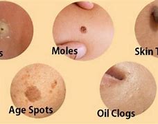 Image result for Skin Tag Wart Remover