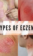 Image result for Types of Eczema