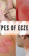 Image result for Eczema