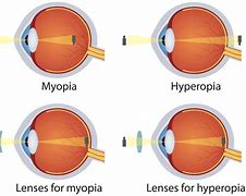 Image result for Myopia of Both Eyes