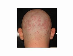 Image result for Small Bumps On Scalp