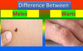 Image result for Wart Mole