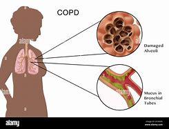 Image result for COPD Virus