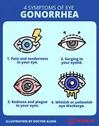 Image result for Gonorrhea of the Eye