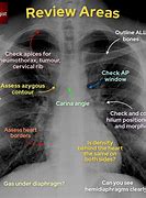Image result for 2 View Chest X-Ray