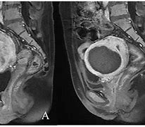 Image result for 5 Cm Uterine Fibroid