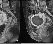 Image result for Uterine Fibroid 15 Cm