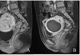 Image result for Pregnancy with Fibroids