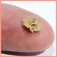 Image result for 2Mm Kidney Stone