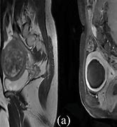 Image result for 8 Cm Uterine Fibroid