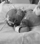 Image result for Gastroschisis