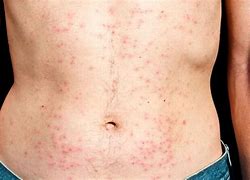 Image result for Yeast Folliculitis